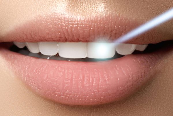 antalya diş beyazlatma